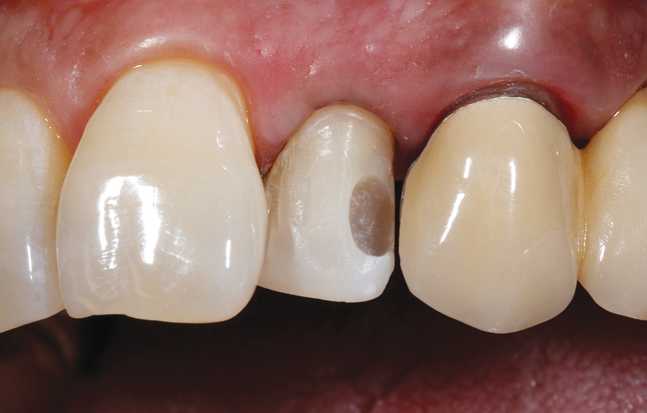 Obr. 8: Krvácení bylo účinně a spolehlivě zastaveno pomocí retrakční pasty.