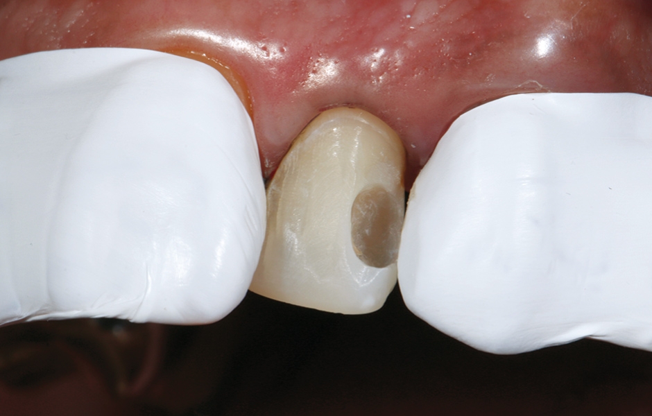 Obr. 9: Oba sousední zuby byly chráněny pomocí teflonové pásky.