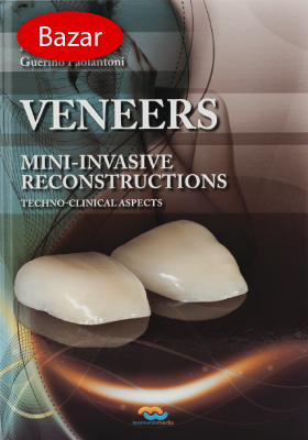 Veneers – Mini-invasive Reconstructions – bazar